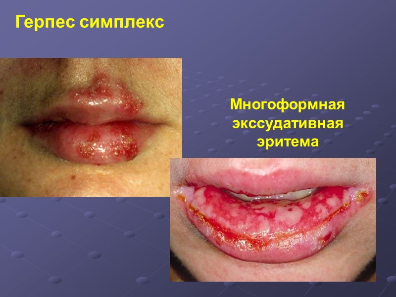 Герпес симплекс Многоформная экссудативная  эритема